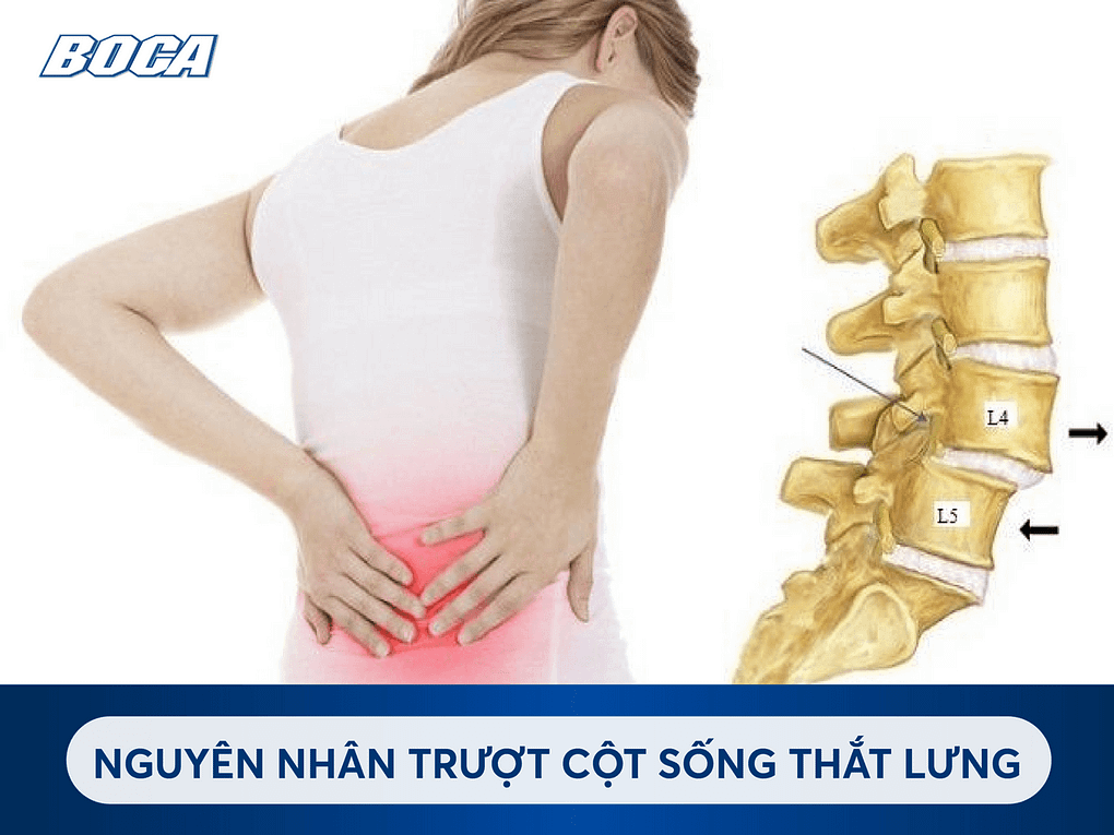 nguyen nhan truot cot song that lung