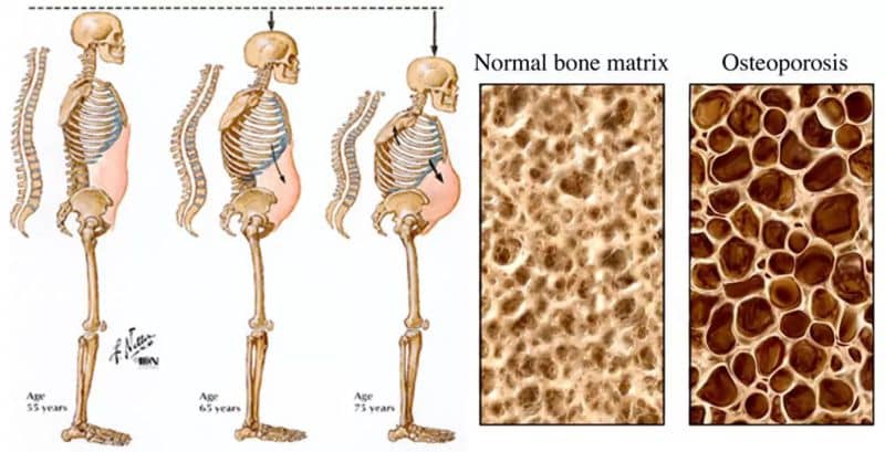Những biến chứng mà bệnh loãng xương gây ra?
