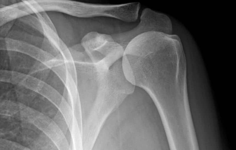 Chụp X-quang để kiểm tra mức độ loãng xương